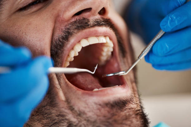Best Emergency Tooth Extraction in Holliday, TX